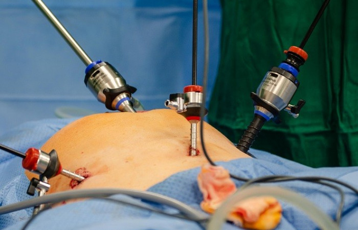 Operacja endoskopowa 