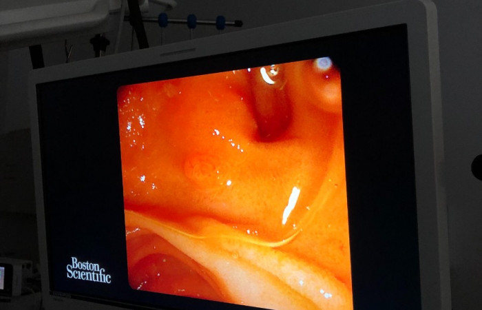 Zbliżenie na ekran wyświetlający kamerę endoskopową 