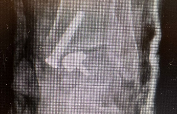 Zdjęcie z zabiegu artroplastyki